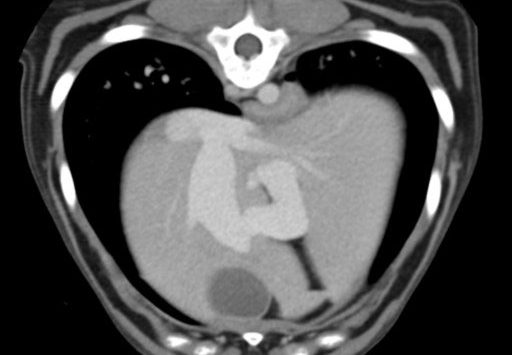 ct_intraheptic_shunt_single_image