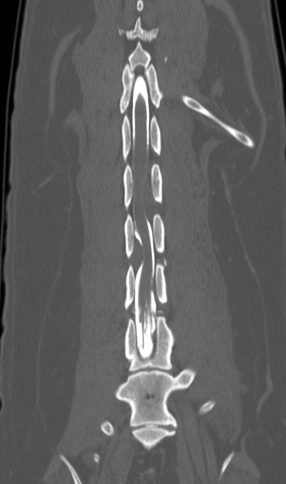 dorsal_ct_myelogram